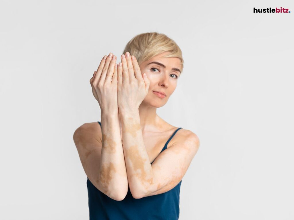 A woman with vitiligo confidently posing.